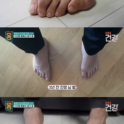 30대 남성 통풍 환자의 발 상태.jpg