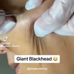 혐주의) 거대 피지낭종 제거 장면.mp4